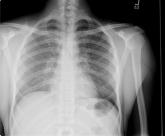 Disseminated histoplasmosis