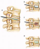 Acute Vertebral Fracture