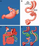 Complications of Bariatric Surgery