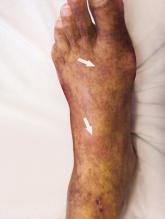 Soft‐tissue gangrene secondary to mixed cryoglobulinemia