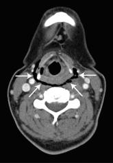 Esophageal Perforation, Complication of EGD