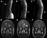 Acute paraplegia in a patient with AIDS and a normal CSF examination