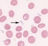 Severe babesiosis