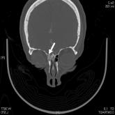 Recurrent Bacterial Meningitis