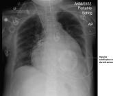 Myocardial Calcification in ESRD