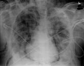 Pneumomediastinum and Pneumopericardium