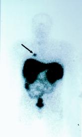 Octreotide Scan for Carcinoids