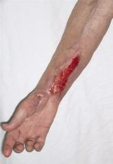 Disseminated Sporotrichosis