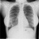 Infected pneumatocele