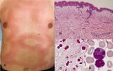 Erythema with Leukemia and Bacteremia