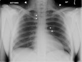 Spontaneous Pneumomediastinum