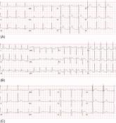 IRIS Presenting as Acute Pericarditis