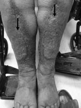 Pretibial Myxedema