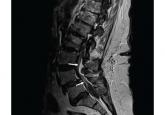 A 69-year-old woman with double vision and lower-extremity weakness