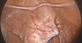 Novel method to demarcate bladder dissection during posthysterectomy sacrocolpopexy