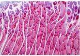 Myopathy for the general internist: Statins and much more