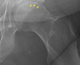 Osteonecrosis of the femoral head with subchondral collapse