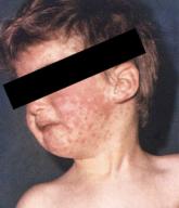 Measles: A dangerous vaccine-preventable disease returns