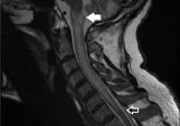Acute-onset quadriplegia with hyperreflexia