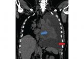 Managing malignant pleural effusion