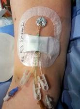 Group creates guide for PICC use