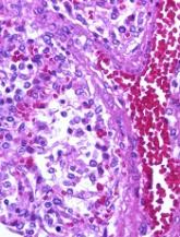 Drug can fight adenovirus in HSCT recipients
