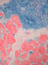 Company stops development of drug for AL amyloidosis