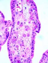 Old drug could treat CMV