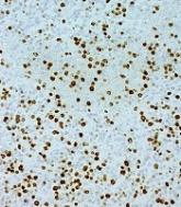 Immunotherapy shows promise in CBCL