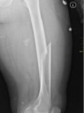 Fracture risk tied to death in women with MM