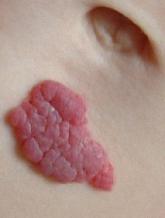 FDA approves drug for infantile hemangioma