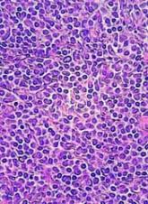 5-year remission rates with combo prove durable in MCL