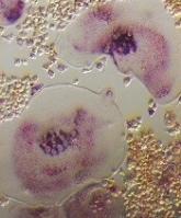 Drugs appear comparable for delaying SREs in MM