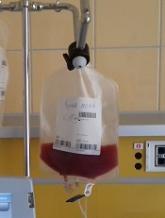 Manufactured graft deemed safe in blood cancer patients