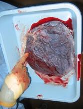 DSCs ‘promising’ for severe acute GVHD