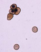 Researchers generate RBCs to treat SCD