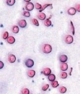 Drivers of cardiac complications in sickle cell anemia