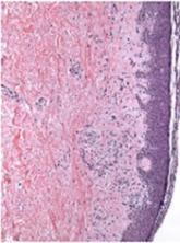 Bortezomib can treat chronic GVHD, study shows