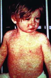 Measles immunization is a major challenge in HIV-infected children
