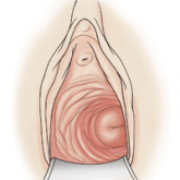 Why are there delays in the diagnosis of endometriosis?