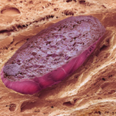 2017 Update on ovarian cancer