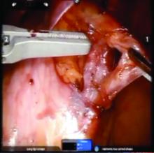 The ovarian vein and artery are separated.