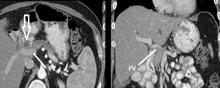 Preoperative CT scan shows borderline resectable pancreatic tumor (white arrow) [left] with portal vein (PV) abutment [right].