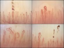 Nailfold capillaroscopy images show progressively worsening damage: microhemorrhage and hemosiderin (top left), an isolated dilated loop (top right), lower capillary density and microhemorrhage (lower right), and architectural derangement (lower left).