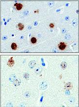 Motor neurons from mice that received an experimental ALS treatment (top) displayed lower levels of a newly identified biomarker (brown areas) than observed in untreated animals (bottom).