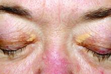 Xanthelasma lesions on a patient's eyelids.