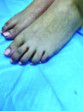 Several non-tender violaceous papules, macules, and patches are evident on the 8-year-old girl's toes