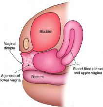 Fig 2a: Hematocolpos with agenesis of the lower vagina.