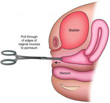 Fig 2b: Pull through vaginoplasty for patient in Fig 2a.