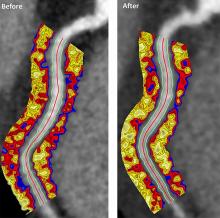 Coronary CT angiography image of the coronary arteries depicting the perivascular fat attenuation index (FAI) before and after biologic therapy